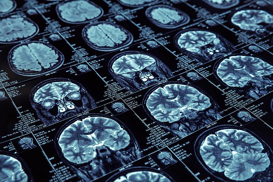 MRI images of a brain
