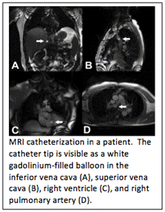 MRI Catherization