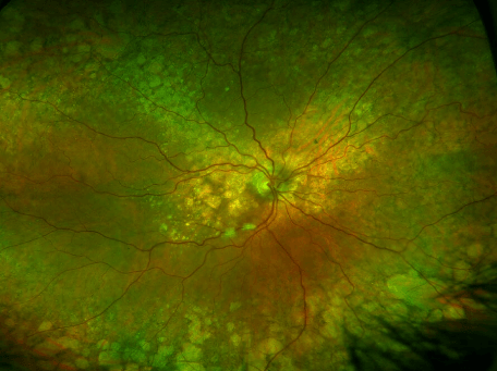 Retina with macular degeneration