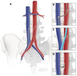 TAVR