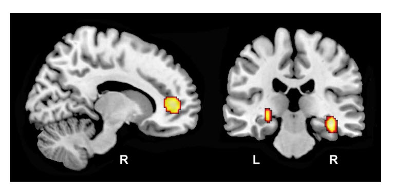 Brain scan indicating significantly greater longitudinal increases in regional cerebral blood flow in carriers of the risk variant C-allele within the right anterior cingulate cortex (left panel) and bilateral hippocampi (right panel) 