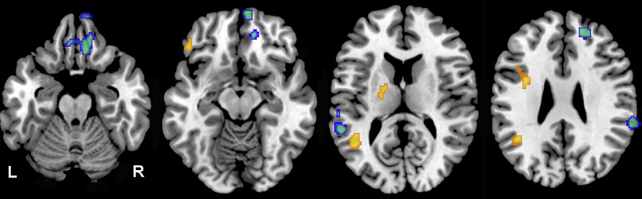 Differences in longitudinal change in regional cerebral blood flow between IGT and NGT groups.