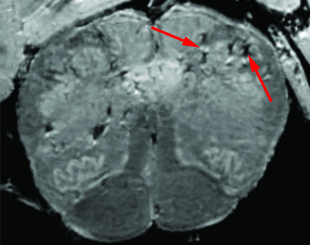 This brain scan of a deceased patient who had COVID-19 shows signs (red arrows) of damaged blood vessels.