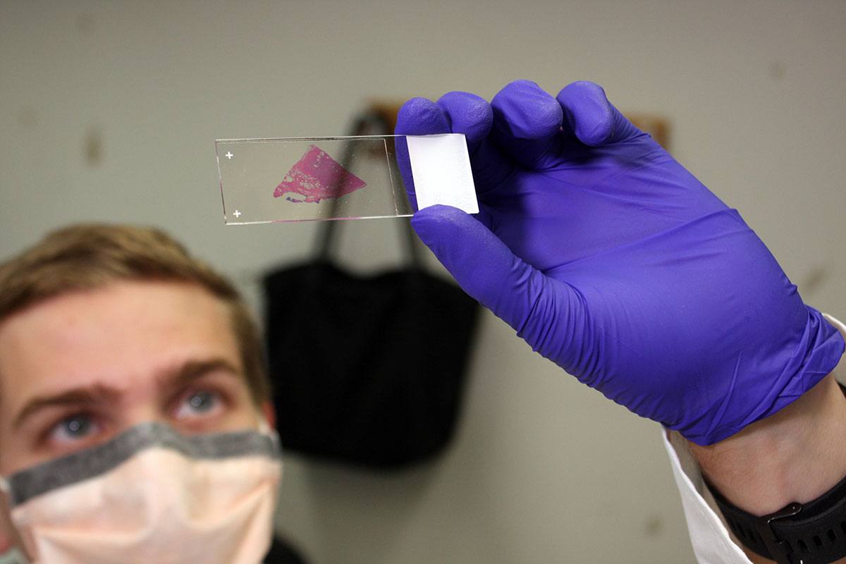 IRP postbaccalaureate fellow Ben Hauck examines a slice of a patient's prostate tumor