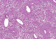 liverpath_fatty_change_1.jpg