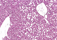 liverpath_fatty_change_2.jpg