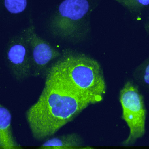 Epithelial pancreatic cells transfected with Brachyury show increased EMT marker expression