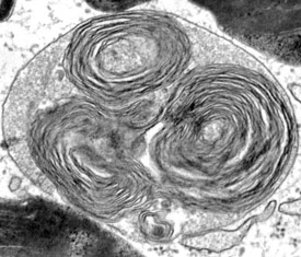 Defective lysosomal function in Mucolipidosis Type IV patients results in accumulation of undegraded material inside lysosomes