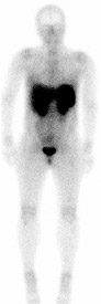 A full-body pentetreotide scan to search for tumors