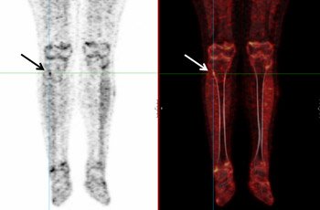 Fluorodeoxyglucose positron emission tomography (left) and FDG-PET/CT merged image (right) helped locate the tumor (arrow).