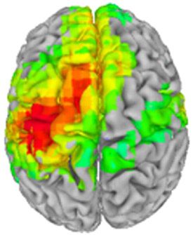 After a single infusion of ketamine, the patient’s stimulus response to finger stroking shows enhanced cortical excitability