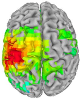 Stimulus-evoked response to stroking of the right index finger in a patient with treatment-resistant major depression, before ketamine infusion
