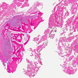 Slices through the tumor excised from Jones’ leg