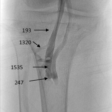 Sampling venous blood for the hormone FGF23 helped to localize the tumor.